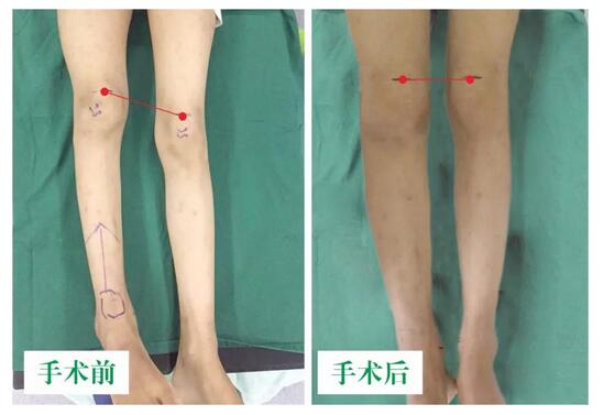 女孩墜梯右腿縮短5cm，幸得醫(yī)生及時(shí)診治恢復(fù)正常腿型