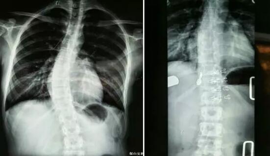 好好的脊柱怎么說彎就彎了？你竟然都沒發(fā)現(xiàn)……