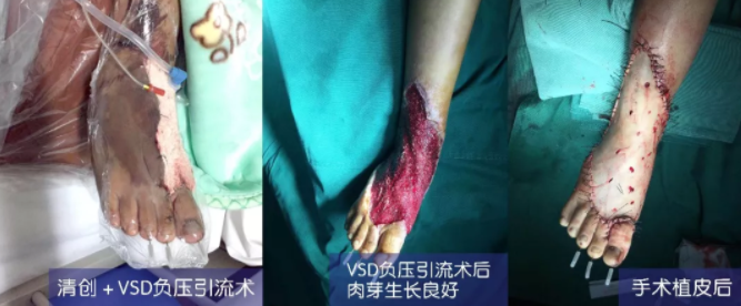 車禍猛如虎，救治如“華佗” ，手術(shù)＋康復(fù)，8歲小女孩車禍后日漸康復(fù)行走