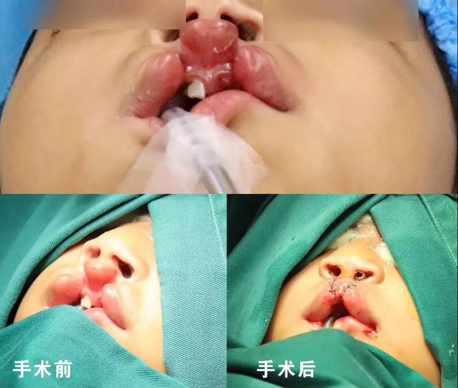 唇腭裂盡早治療消除孩子自卑心理，快樂成長！