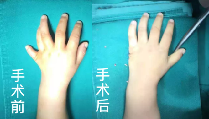 【保山安利醫(yī)院】2歲小兒手、足多指（趾）成功修復(fù)(矯正）！