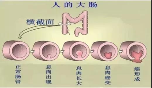 體檢發(fā)現(xiàn)腸息肉會癌變嗎？
