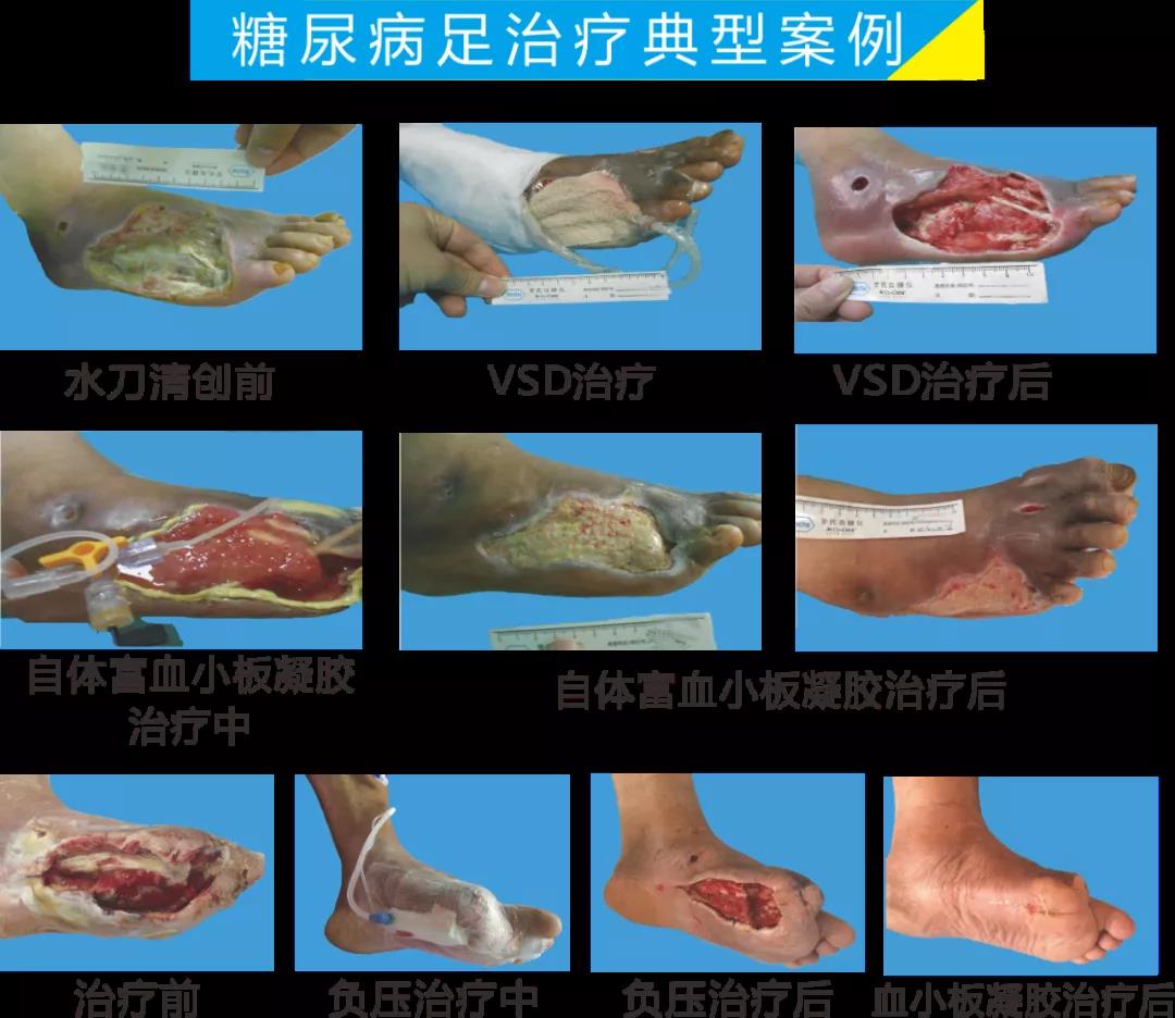 截肢、失明，甚至……，我們要做的是將糖尿病并發(fā)癥遏制在搖籃里！