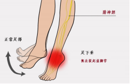 【保山安利醫(yī)院—健康科普】什么是足下垂！你了解嗎？