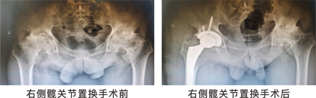 【保山安利醫(yī)院】長(zhǎng)期飲酒導(dǎo)致雙側(cè)股骨頭壞死，髖關(guān)節(jié)置換后重獲運(yùn)動(dòng)功能！
