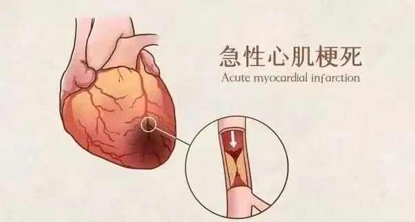 【保山安利醫(yī)院】11月20日“心梗救治日” 時(shí)間就是心肌，時(shí)間就是生命！